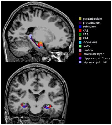 Oxidative stress impairs cognitive function by affecting hippocampal fimbria volume in drug-naïve, first-episode schizophrenia